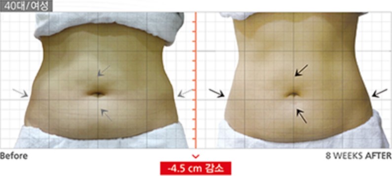 전후사진